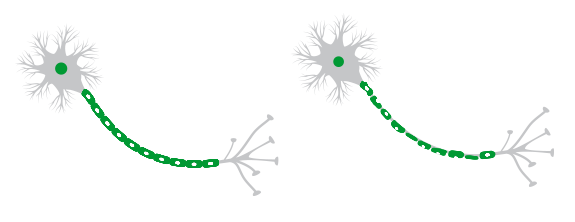 A sinistra una fibra nervosa integra, a destra una fibra nervosa demielinalizzata. Le aree in cui la mielina è stata danneggiata o distrutta vengono definite “placche” o “lesioni”, che appaiono come aree indurite (cicatrici):